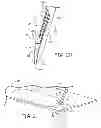Fig. 16 - Minimally invasive implantable neurostimulation system