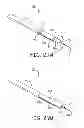 Fig. 20 - Minimally invasive implantable neurostimulation system