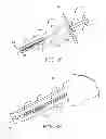 Fig. 22 - Minimally invasive implantable neurostimulation system
