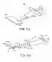 Fig. 23 - Minimally invasive implantable neurostimulation system