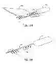 Fig. 25 - Minimally invasive implantable neurostimulation system