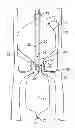 Fig. 01 - Shockwave catheter