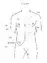 Fig. 06 - Methods and apparatus to increase secretion of endogenous naturetic hormones