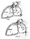 Fig. 02 - Filter apparatus for ostium of left atrial appendage