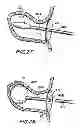Fig. 09 - Filter apparatus for ostium of left atrial appendage