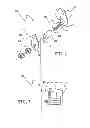 Fig. 02 - Interspinous internal fixation/distraction device