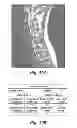 Fig. 08 - High density epidural stimulation for facilitation of locomotion, posture, voluntary movement, and recovery of autonomic, sexual, vasomotor, and cognitive function after neurological injury