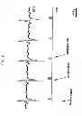 Fig. 11 - Microburst electrical stimulation of cranial nerves for the treatment of medical conditions