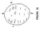 Fig. 12 - Microburst electrical stimulation of cranial nerves for the treatment of medical conditions