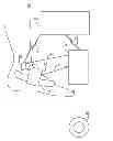 Fig. 01 - Minimally invasive implantable neurostimulation system