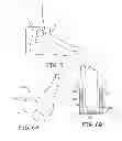 Fig. 05 - Minimally invasive implantable neurostimulation system