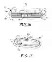 Fig. 12 - Minimally invasive implantable neurostimulation system
