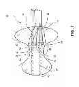 Fig. 03 - METHOD FOR TREATING AND REPAIRING MITRAL VALVE ANNULUS