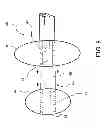 Fig. 06 - METHOD FOR TREATING AND REPAIRING MITRAL VALVE ANNULUS