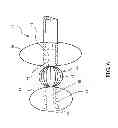 Fig. 07 - METHOD FOR TREATING AND REPAIRING MITRAL VALVE ANNULUS
