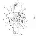 Fig. 09 - METHOD FOR TREATING AND REPAIRING MITRAL VALVE ANNULUS