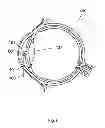 Fig. 07 - Apparatus And Method For The Treatment of Cataract