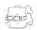 Fig. 01 - Minimally invasive intervertebral staple distraction devices