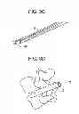 Fig. 04 - Minimally invasive intervertebral staple distraction devices