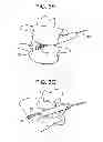 Fig. 06 - Minimally invasive intervertebral staple distraction devices