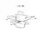 Fig. 07 - Minimally invasive intervertebral staple distraction devices