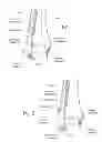 Fig. 02 - Malleolar Replacement Devices