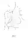 Fig. 02 - METHODS AND COMPOSITIONS FOR MINIMALLY INVASIVE CAPSULAR AUGMENTATION OF CANINE COXOFEMORAL JOINTS
