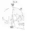 Fig. 22 - Securable implantable component