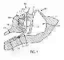 Fig. 02 - DEVICE TO SECURE AIRWAY DURING EMERGENCY CARE