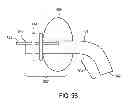 Fig. 09 - DEVICE TO SECURE AIRWAY DURING EMERGENCY CARE