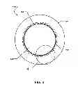 Fig. 04 - Torque limiting tolerance ring