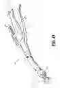 Fig. 28 - DISSECTION TIP AND INTRODUCER FOR SURGICAL INSTRUMENT