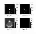 Fig. 13 - Magnetic resonance fingerprinting (MRF) with echo splitting