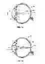 Fig. 02 - Multi-ring lens, systems and methods for extended depth of focus