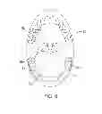 Fig. 08 - Actuator systems for oral-based appliances