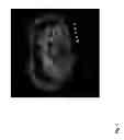 Fig. 16 - NON-INVASIVE IMAGING METHODS FOR PATIENT SELECTION FOR TREATMENT WITH NANOPARTICULATE THERAPEUTIC AGENTS