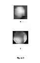 Fig. 03 - Methods and compositions suitable for improved reattachment of detached cartilage to subchondral bone
