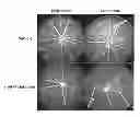 Fig. 01 - METHODS AND COMPOSITIONS FOR TREATING CONDITIONS ASSOCIATED WITH ANGIOGENESIS USING A VASCULAR ADHESION PROTEIN-1 (VAP-1) INHIBITOR