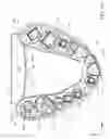 Fig. 04 - Method of making a dental arch model