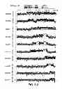 Fig. 15 - Compositions And Methods For The Diagnosis of Schizophrenia