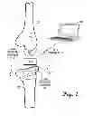 Fig. 02 - Sensored prosthetic component and method