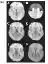 Fig. 02 - Method for deep brain stimulation targeting based on brain connectivity
