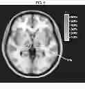 Fig. 06 - Method for deep brain stimulation targeting based on brain connectivity