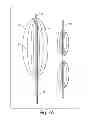 Fig. 05 - Expandable device for tissue collection from an aerodigestive body lumen