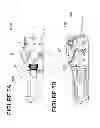 Fig. 10 - Catheter system providing step reduction for postconditioning