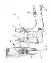 Fig. 20 - Catheter system providing step reduction for postconditioning