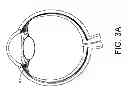 Fig. 03 - Drug delivery devices and methods