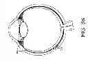 Fig. 04 - Drug delivery devices and methods