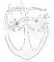 Fig. 01 - Transseptal sheath with air bubble trap
