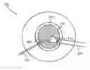 Fig. 01 - CORNEAL MULTI-PLANE INCISION USING A SURGICAL LASER SETUP CALCULATIONS INTERFACE